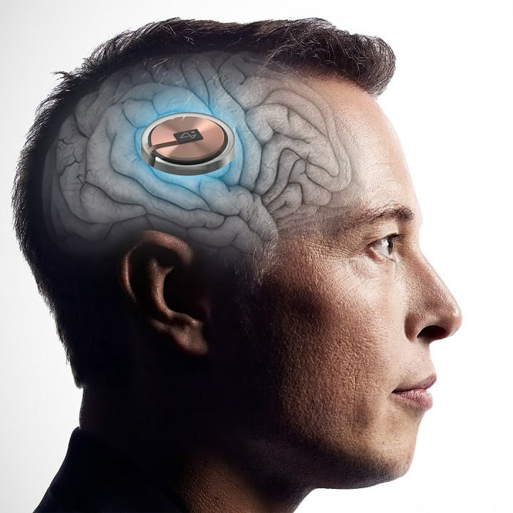 Elon Musk'tan Tarihi Açıklama: Beyin Çipi Nakledilen Hasta Tamamen İyileşti!